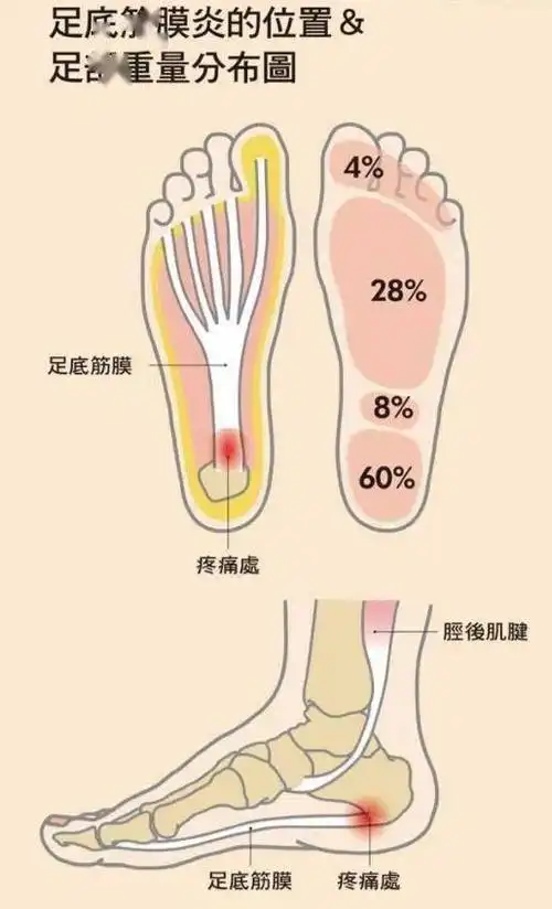 对于足底筋膜炎,比较典型的症状是晨起下床足部接触地后或久坐后步行