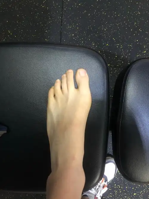 18岁小伙这种情况是拇外翻吗?要手术吗?看大脚骨医生的建议