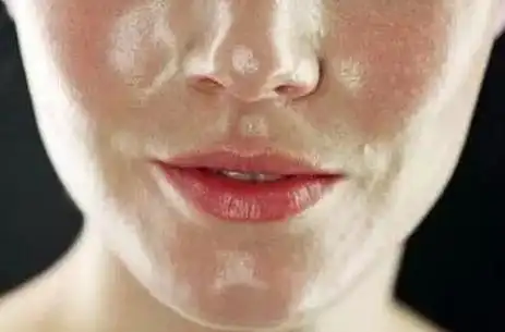 p>油性皮肤是因人体皮脂腺分泌旺盛所产生的,皮肤中的皮脂腺特性由