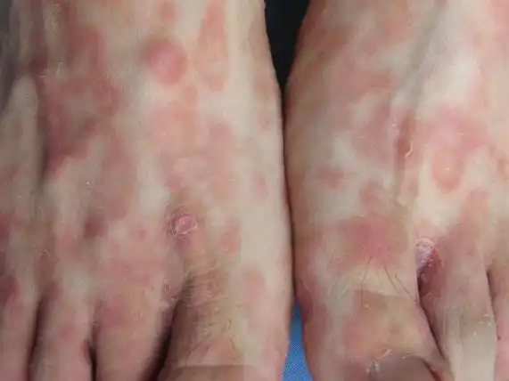 临高县梅毒专家_临高县治疗梅毒哪个专家好_临高县治疗梅毒最好的专家