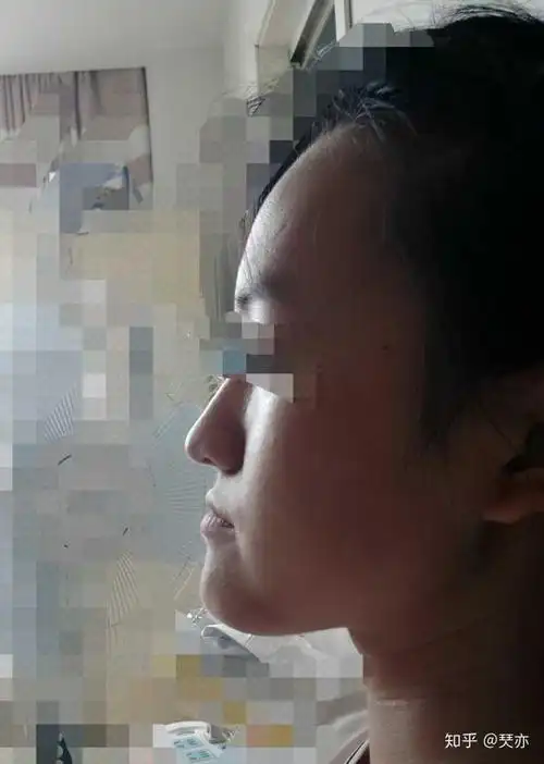 下巴前突,但并不是地包天,很自卑,怎么办?