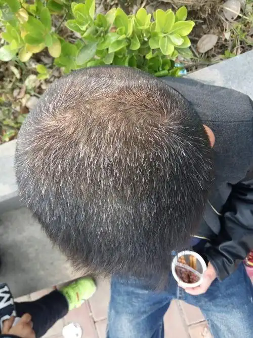 男孩七岁,头发这么多白发,请问医生这怎么治疗.