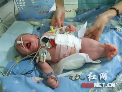 "人鱼"患儿病情危急 出现颅内出血等症状(组图)