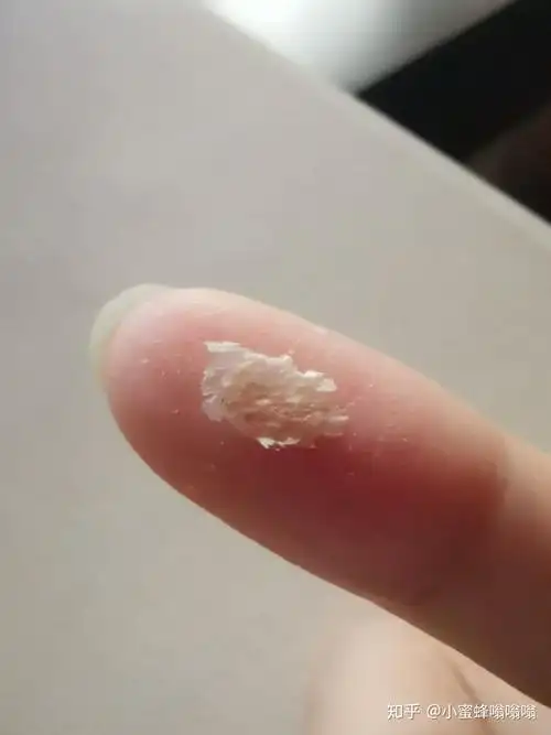 为什么抠下来大块的头皮屑会有瞬间的快感