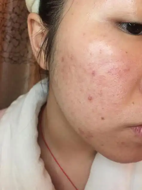 油性痘痘肌护肤品排行 20岁油性面板痘痘肌女生用什么护肤品好