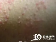 尖锐湿疣又称之为尖圭湿疣,生殖器疣,尖锐疣,性病疣.