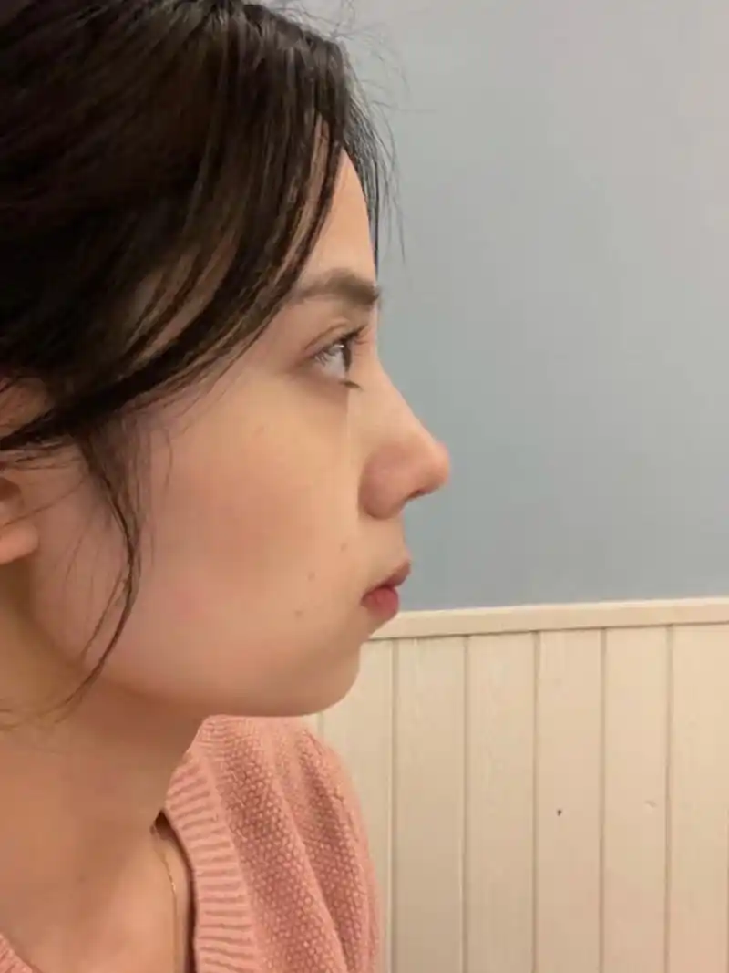 驼峰鼻好看大概仅限微驼.