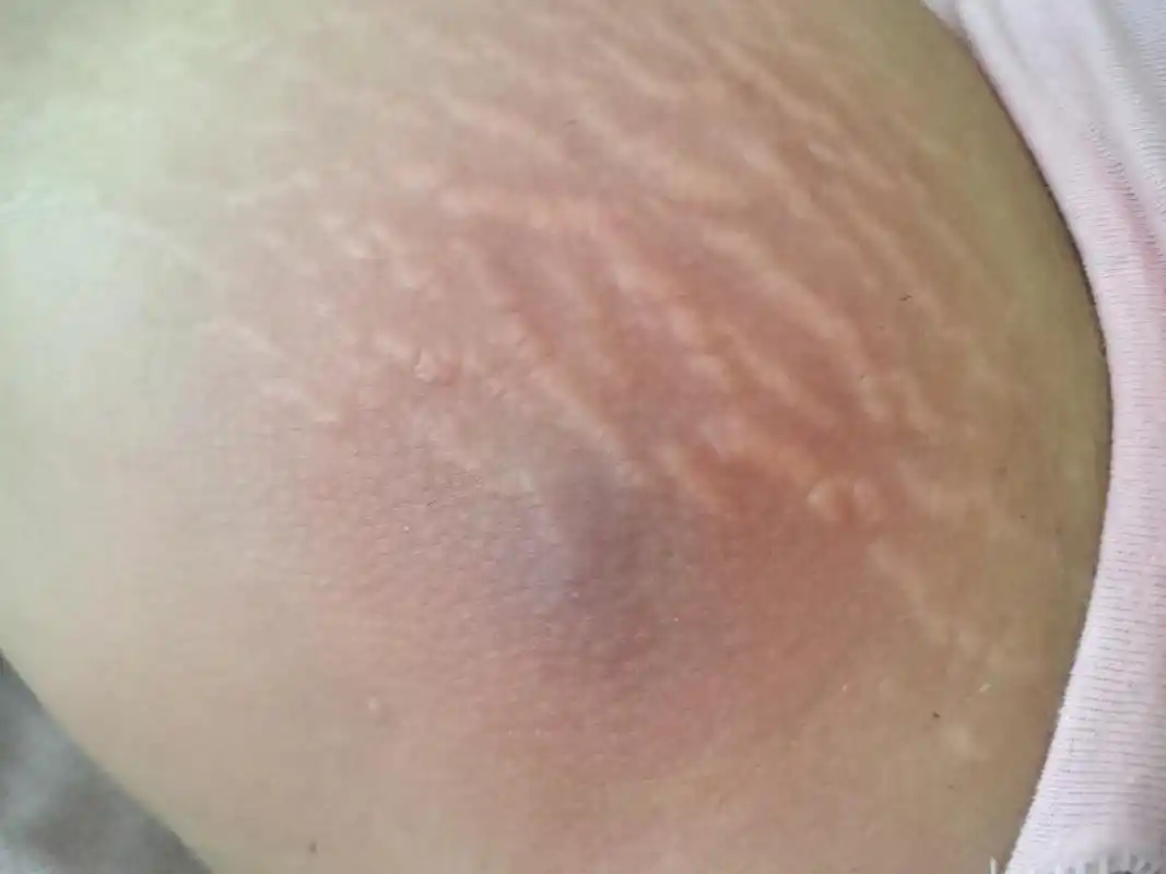 火疖子第三天,疼的没法动,谁有妙招支一下.