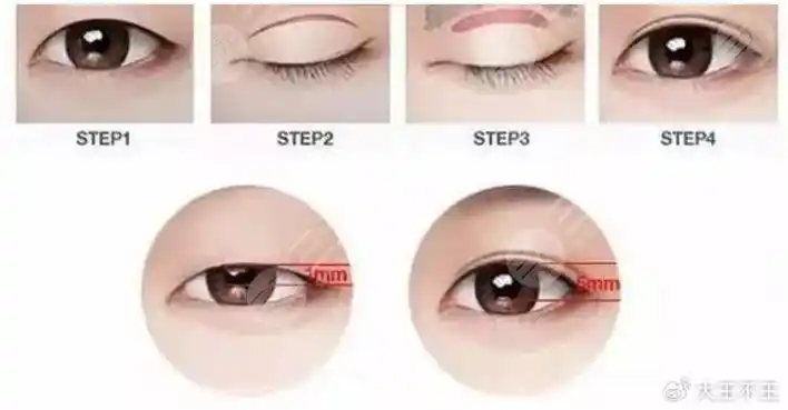 双眼皮种类全切和埋线哪种好?两种原理优势对比!