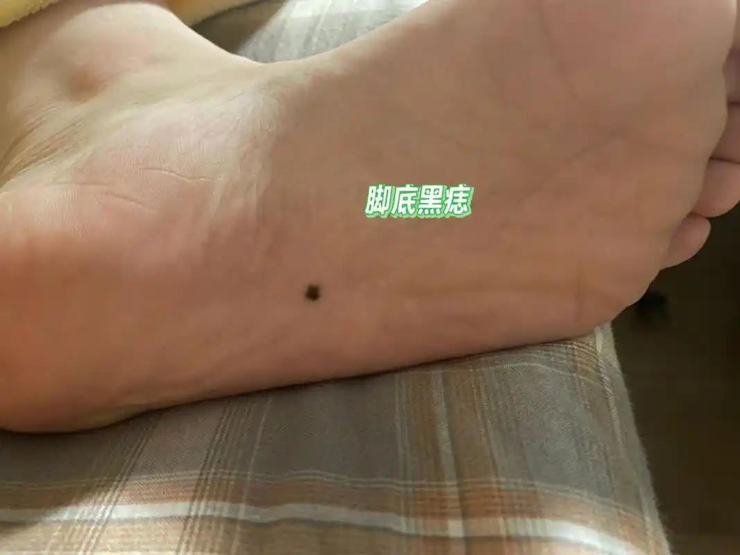 脚底黑痣 我的脚底痣应该长了有小10年了,之前从未在意,且有种迷信