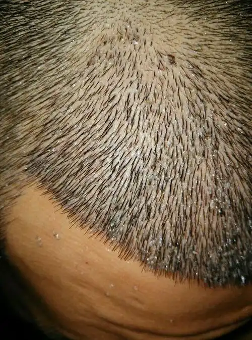 2019-05-21 楼主 给大家看下细节,看着很恶心,满是结痂,第八天,洗头