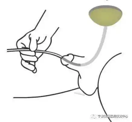 第四步拔管:彻底排空膀胱,拔出导尿管.第五步处理用物,做好记录.