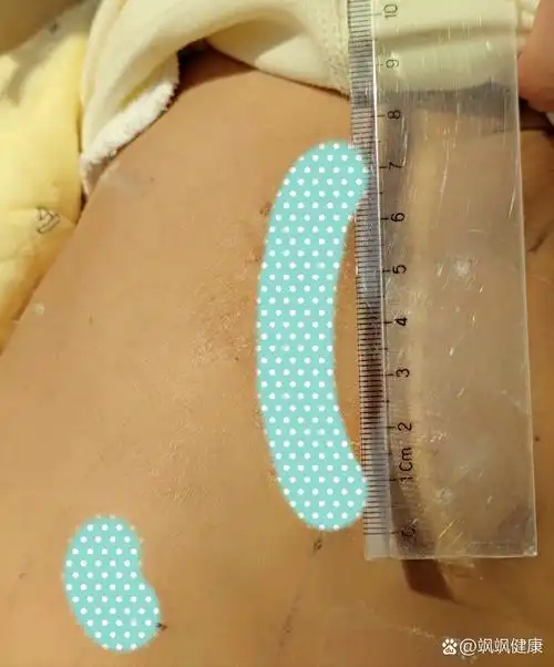 隔缺损手术分享(二) br>看第一张图片见过侧切腋下小切口这么长的吗?