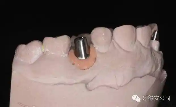 种植牙个性化基台的实用性