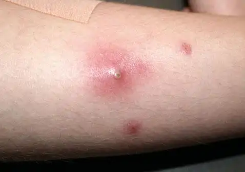 毛囊被小脓包或红色肿块包围.