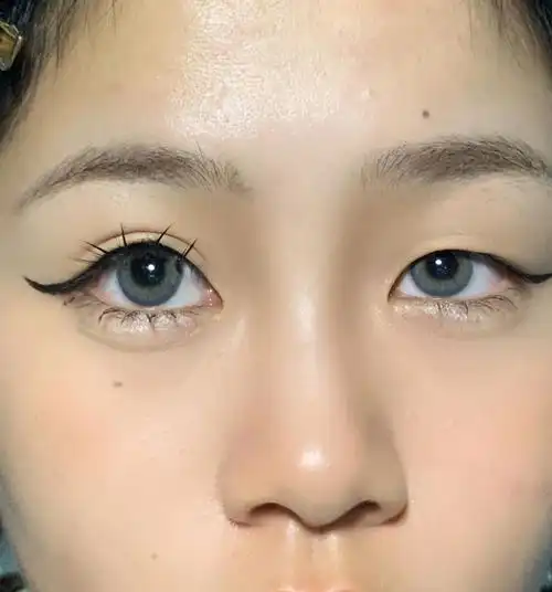 单眼皮变双眼皮