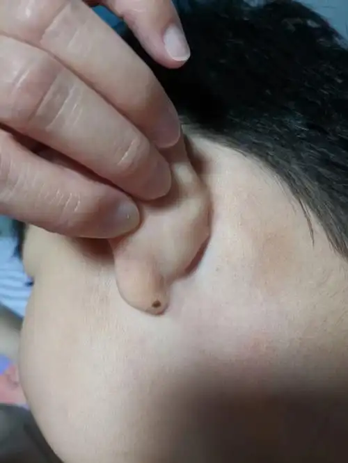 闺女左耳垂后面有颗痣请问有什么说法吗