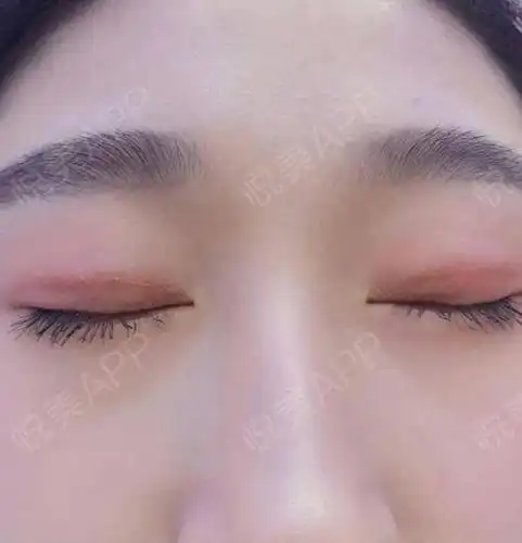 全切双眼皮术后80天_眼综合术后80天_双眼皮术后80天_眼部整形术后80