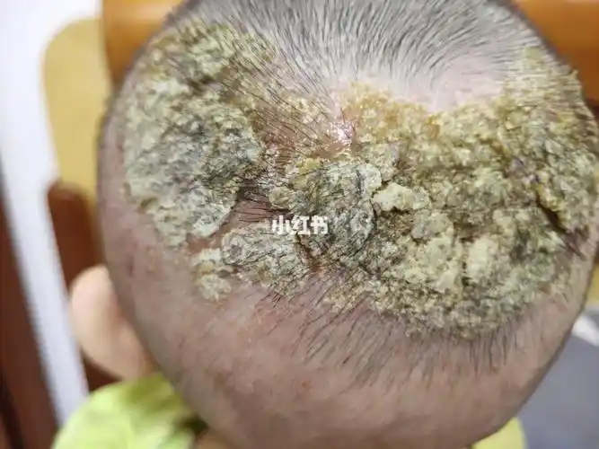 急急急宝宝脑袋上湿疹渗水结痂结痂部位又渗水了有的掉了又重新结痂