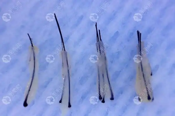 每个毛囊里通常长有1-4根头发