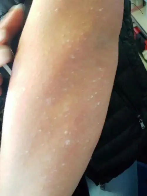 为什么手臂上会生这种痘痘一抓就变成白色几好像皮肤很干一样 而且还