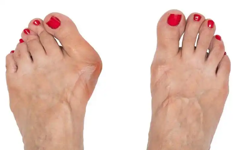 什么是拇外翻?为什么会得?如何预防和治疗?