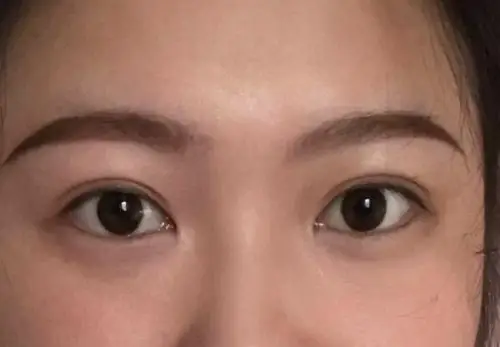 6mm平行双眼皮恢复案例