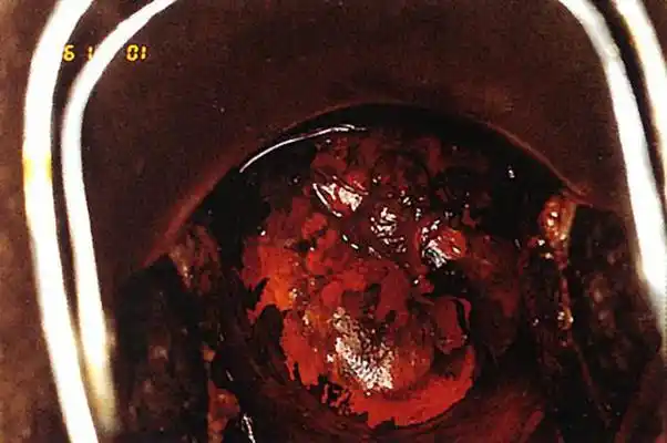 宫颈癌图片 (32)