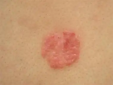 由于长时间的工作都可能会引起患者出现了牛皮癣的症状,如果出现了