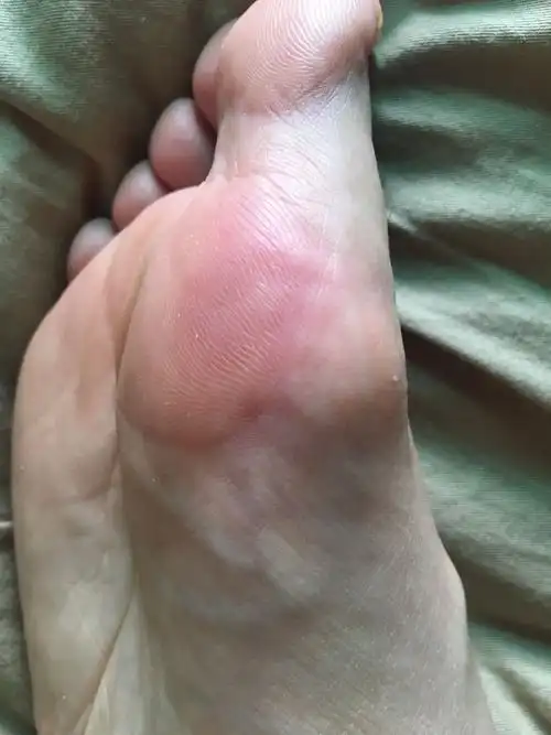 脚底出暗红色斑块热痒微疼