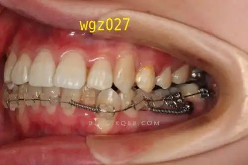 思考她的下颌尖牙如何排入牙列的原创