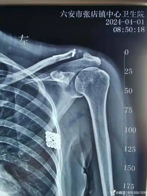 肩锁关节脱位4年