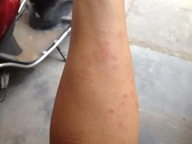 分享到:  2014-10-13 14:57 提问者采纳 可能为  过敏性皮炎湿疹 主要