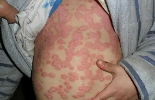 银屑病有哪些症状图片_银屑病求医网