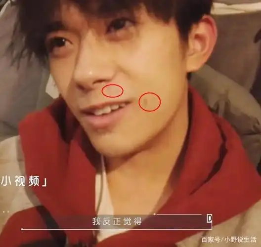 易烊千玺失去滤镜保护,青春痘皮肤差,还是你的爱豆吗