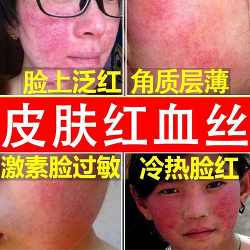 安安金纯(agensn)a&aposgensn脸上红血丝角质层薄敏感肌红血丝高原红