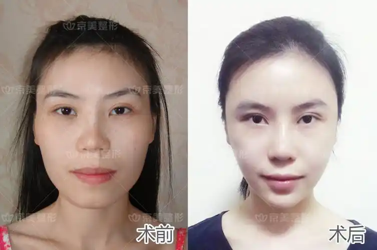 自体脂肪面部填充的手术过程需要进过脂肪的抽取,脂肪分离提纯,脂肪