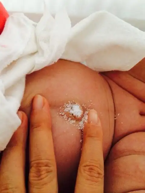 女儿6周大,肚脐上有个肉芽被诊断是脐茸(umbilical granuloma).