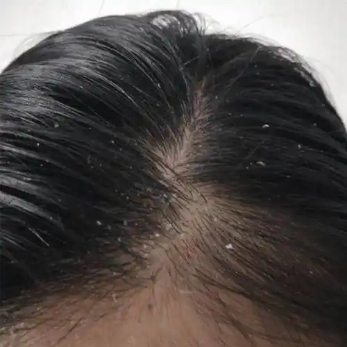 专研去屑净爽洗发乳头皮屑和头油问题一直以来都是困扰着很多人的头疼