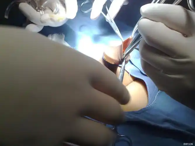 【进展】包皮套扎全过程高清图片