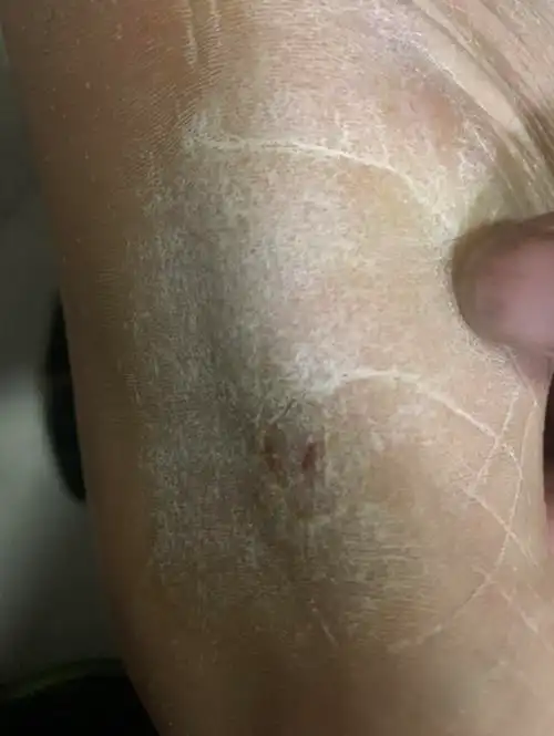 双层侧足底内侧瘙痒伴角质层增厚