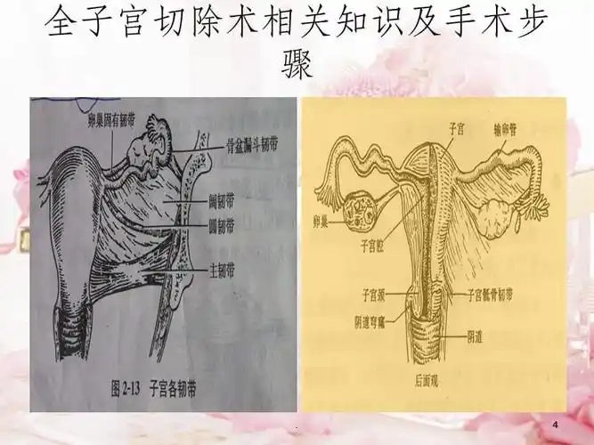 经腹全子宫切除术相关知识及手术步骤