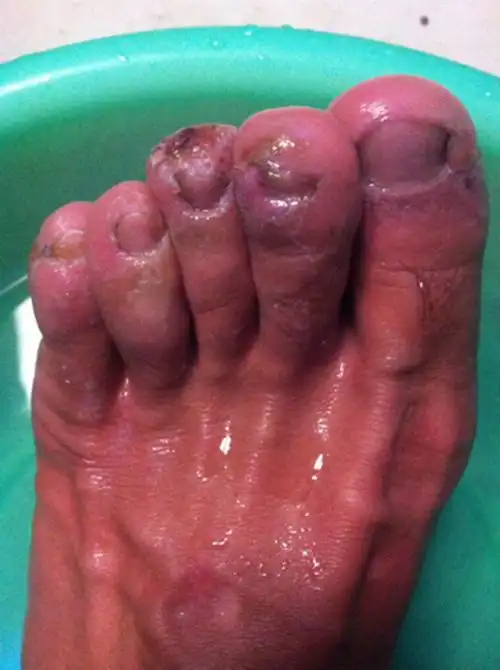艾滋病严重脚溃烂图片