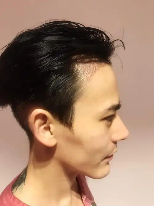 成美植发中心男性种植发际线15天效果