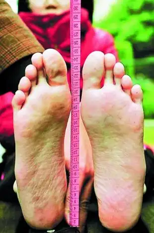 12岁女孩长大脚43码鞋还穿不下(图)