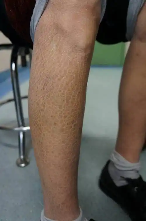 成年鱼鳞病要警惕恶性肿瘤_银屑病_疾病介绍_介绍 - 好大夫在线