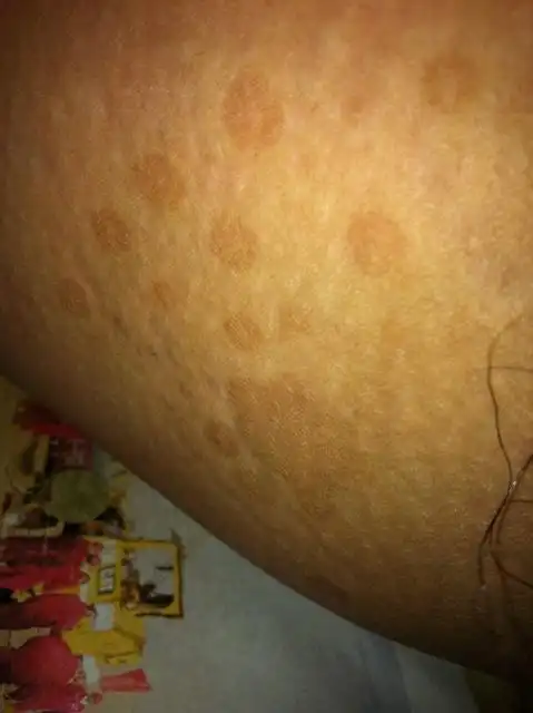 2013-08-18 大腿内侧长了红色长条不痛不痒 而且还有黑色的斑有时候