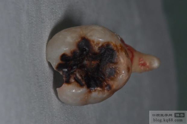 最近拔除的一颗弯根下颌第三磨牙