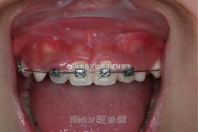 929292上颌尖牙是除第三磨牙外最易阻生的恒牙,患病率为1%-3%