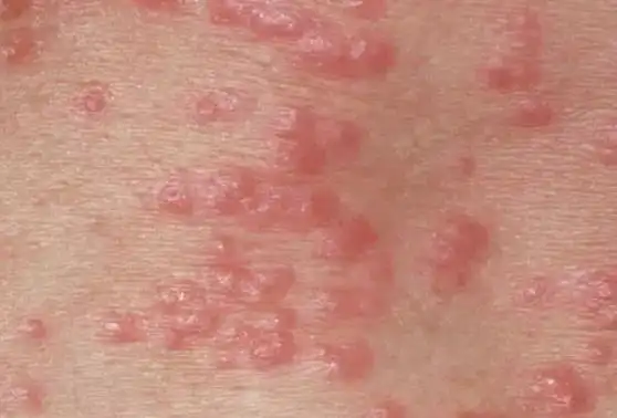 然而,没想到有一天我会因为螨虫过敏身上起一大片一大片的红疹,这个